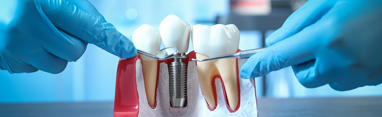 Dental implant consultation